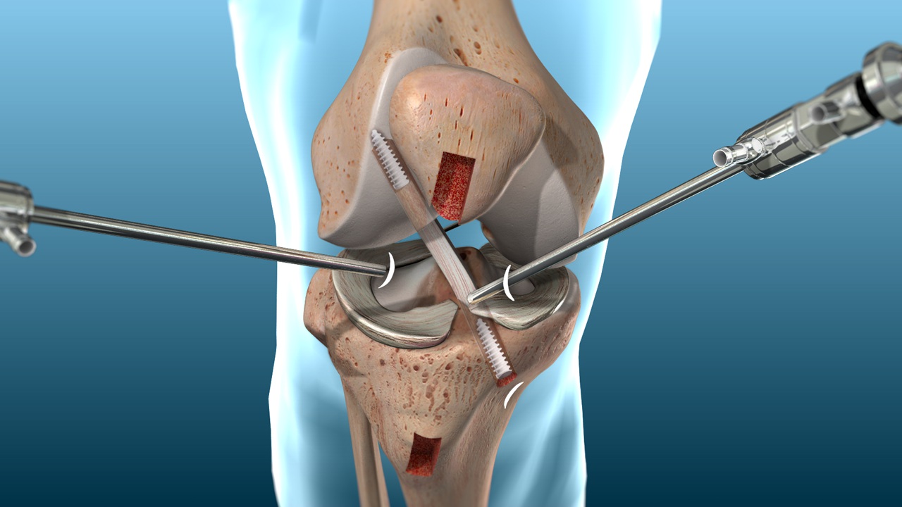 acl_1280