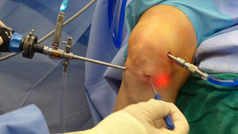 arthroscopic-knee-surgery