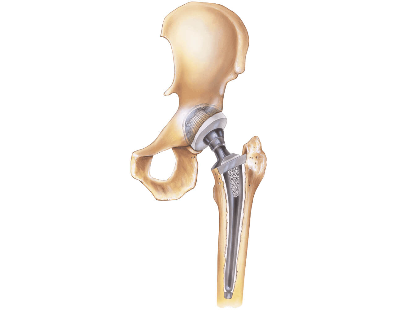 illustrated-hip-replacement-hero